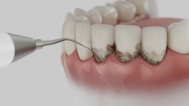 Trusted Dental Crowns And Bridges service in Mount Vernon, MO - Dentist Open Now
